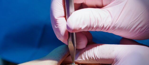 Dental Cavity Prevention: What You Need to Know?