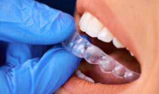 How Do Clear Aligners Compare with Traditional Braces in Functionality?