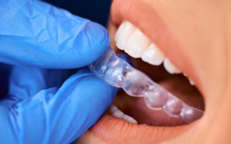 How Do Clear Aligners Compare with Traditional Braces in Functionality?