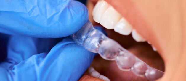 How Do Clear Aligners Compare with Traditional Braces in Functionality?
